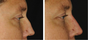 Non Surgical Rhinoplasty[1]