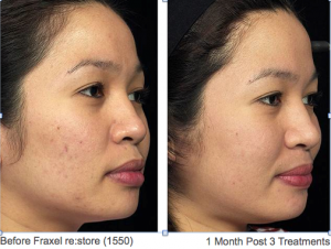 Acne Scarring Before & After